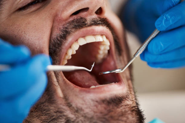 Best Emergency Wisdom Teeth Removal in Shingle Springs, CA